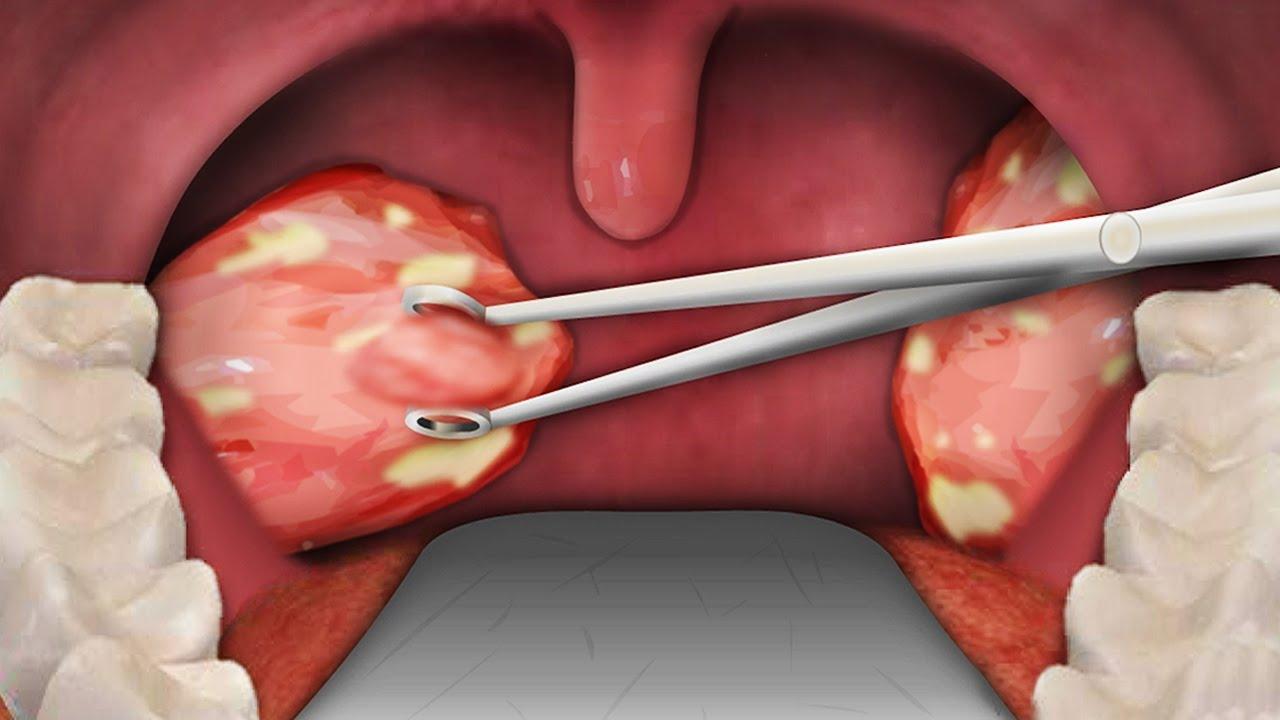 Tonsillectomy Surgery